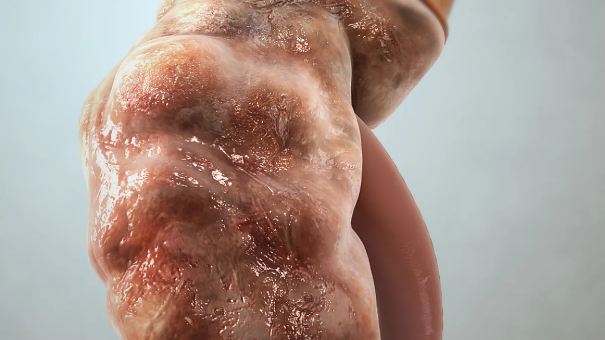 Chronic Kidney Disease (CKD)