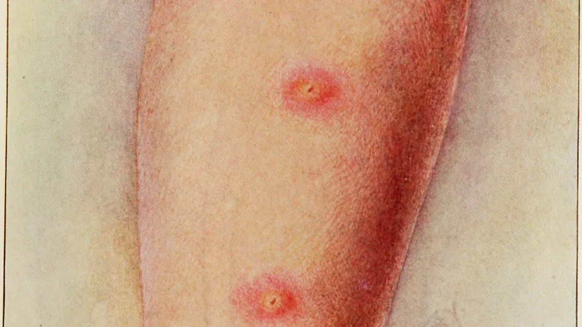 Mantoux Test