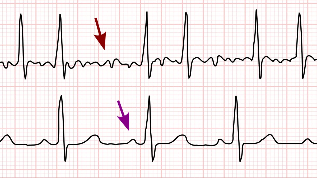 Atrial Fibrillation