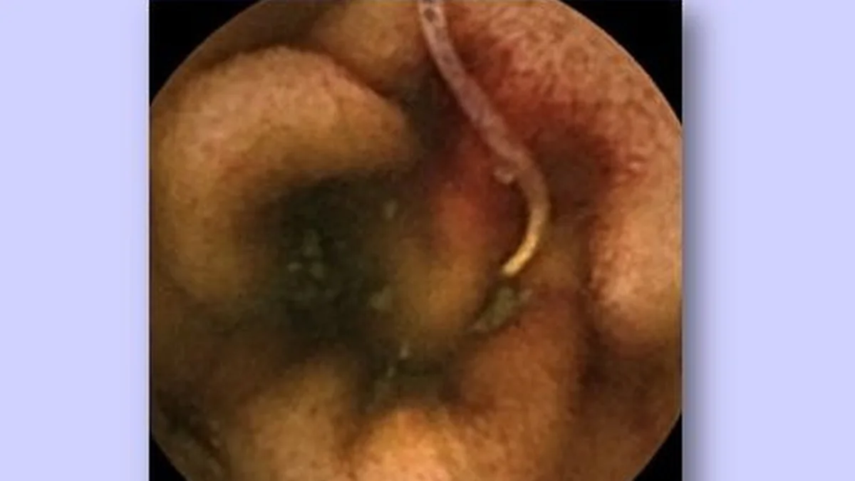 Capsule Endoscopy