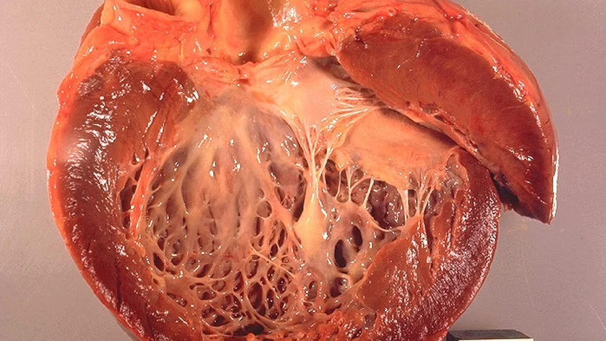 Cardiomyopathy