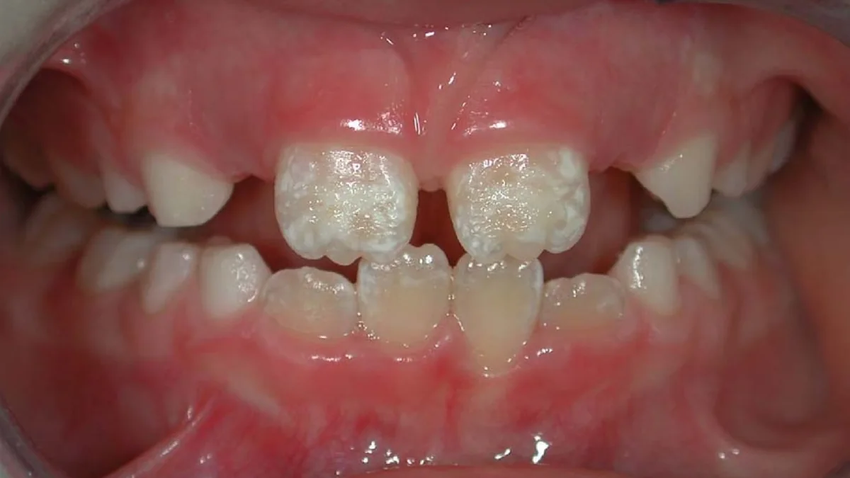 Celiac Disease