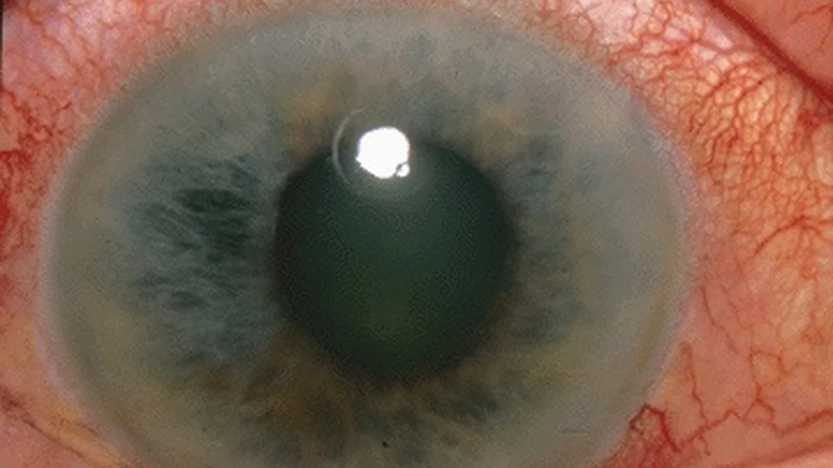 Glaucoma