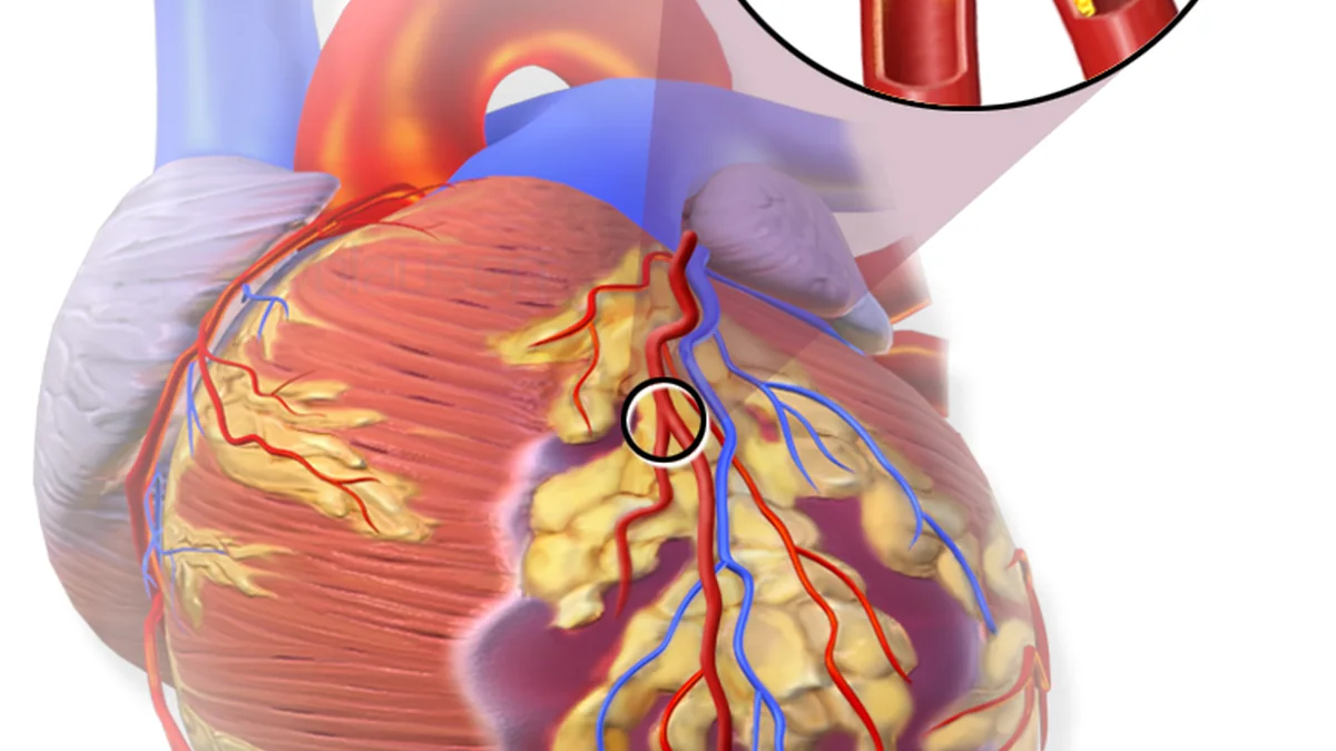 Heart Attack (Myocardial Infarction)