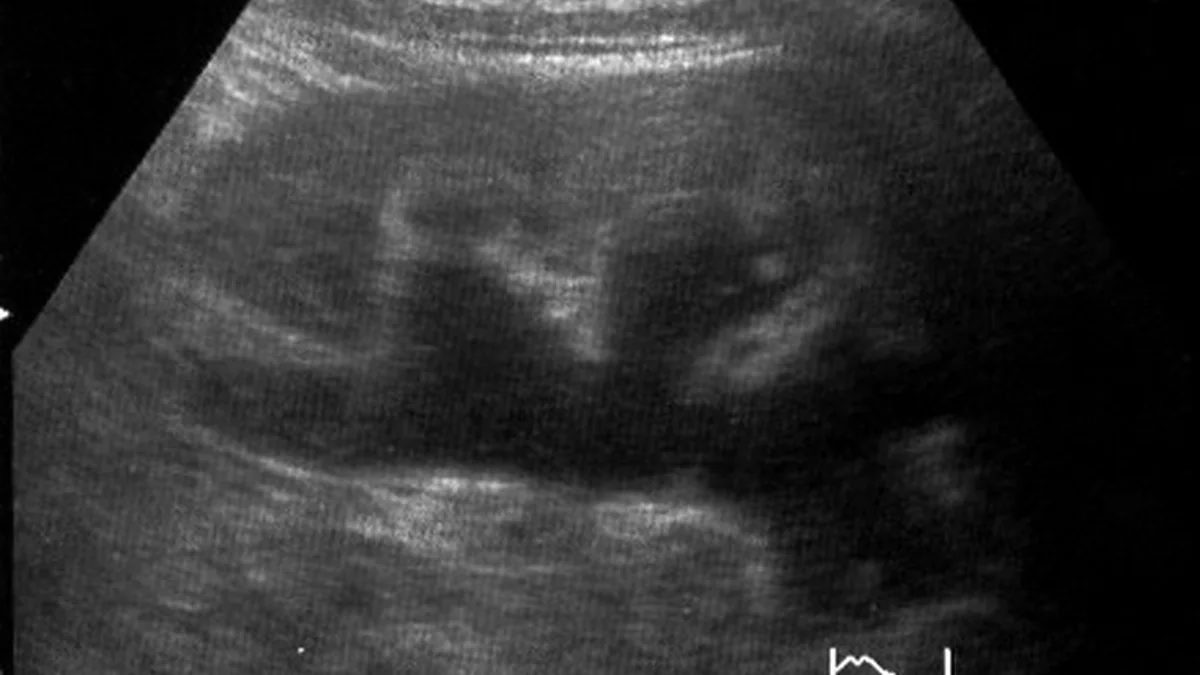 Hydronephrosis