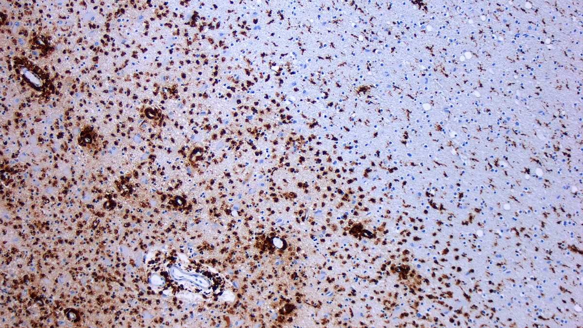 Multiple Sclerosis