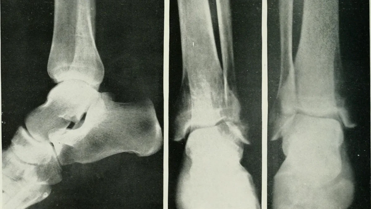 Osteoporosis
