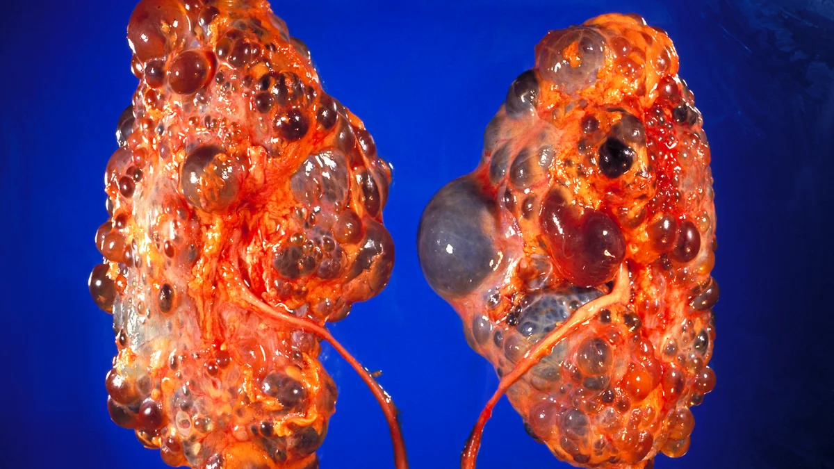 Polycystic Kidney Disease (PKD)