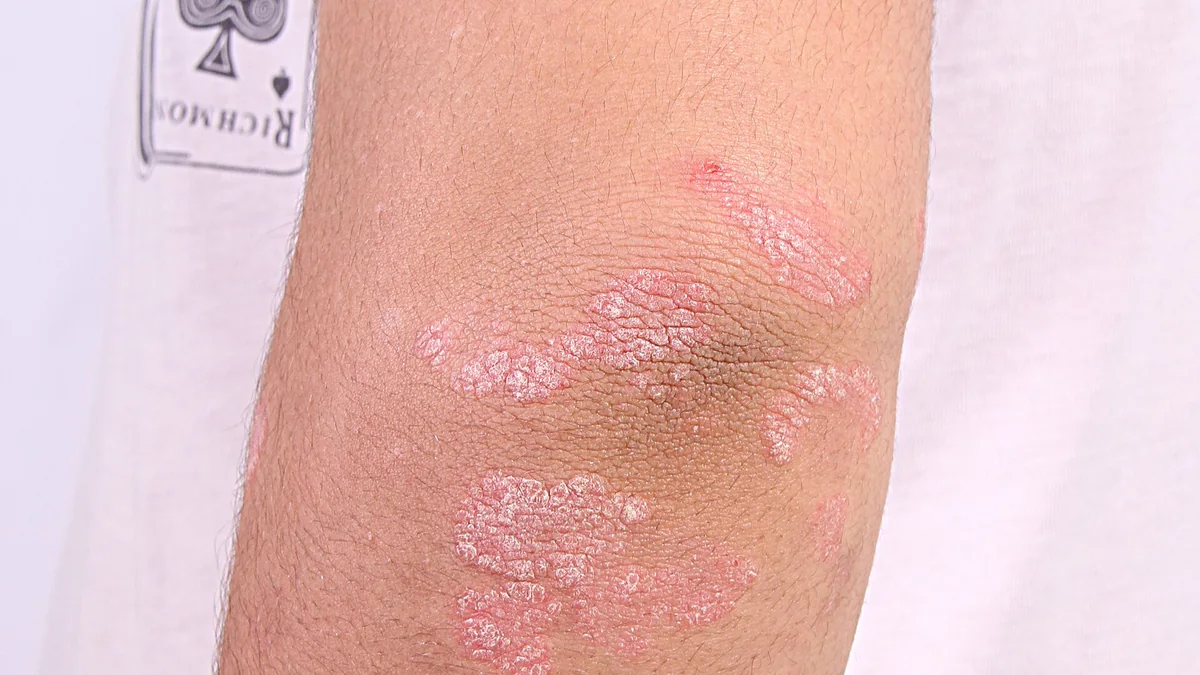 Psoriasis