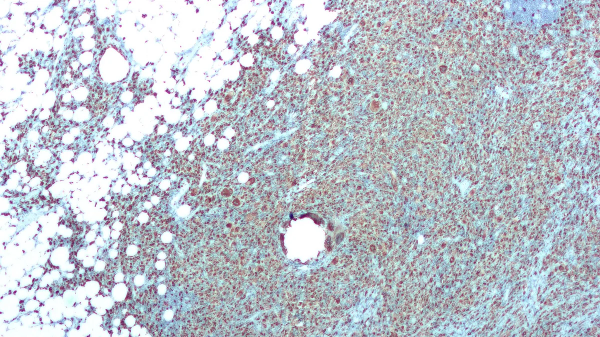 Pyelonephritis (Kidney Infection)