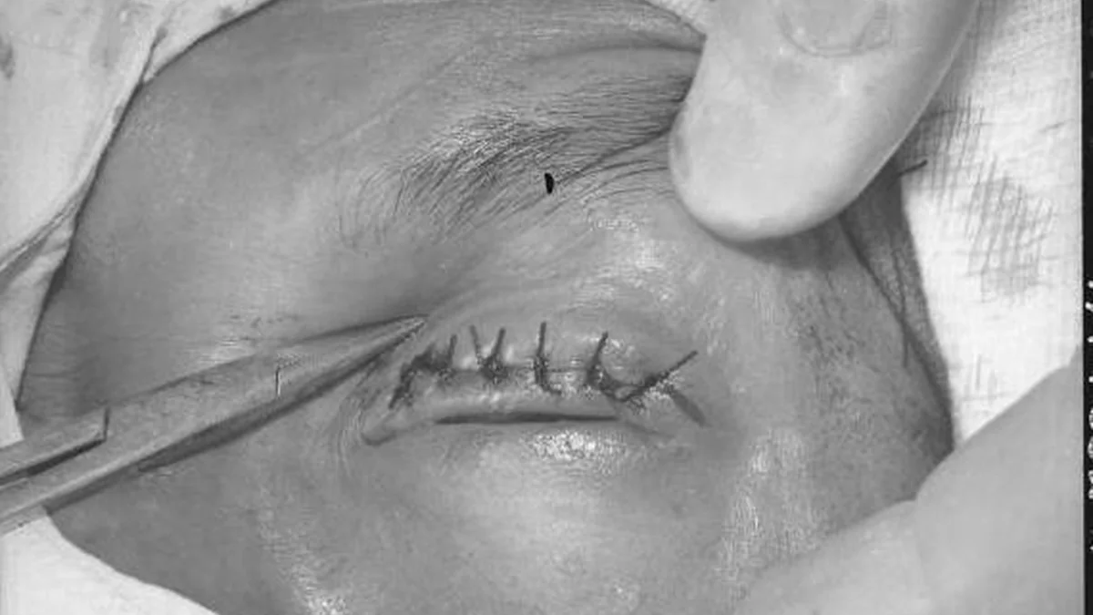 Trachoma
